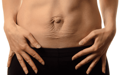 Cómo saber si tengo diástasis abdominal