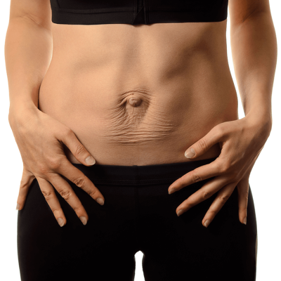 Cómo saber si tengo diástasis abdominal